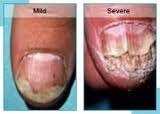antifungal treatment nail fungus cause nail fungus  toenails tea tree oil natural remedies nail fungus fungus 
