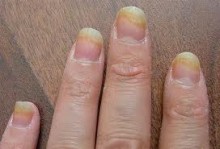 Nail Fungus