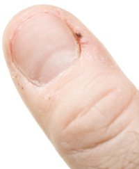Hangnail Infection