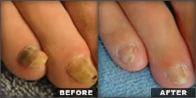 Fungal Nail Treatment
